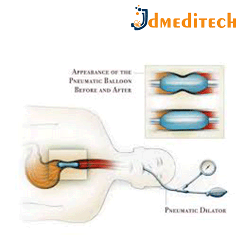 Achalasia Balloon Dilator jdmeditech