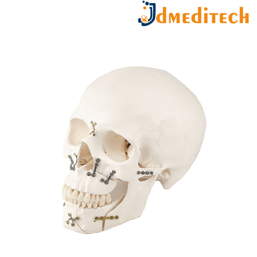 Orthopedic Implants jdmeditech