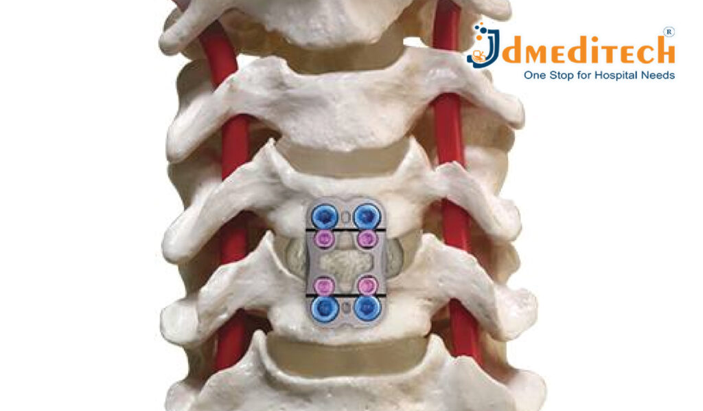 ACDF (Anterior Cervical Discectomy And Fusion) Surgery