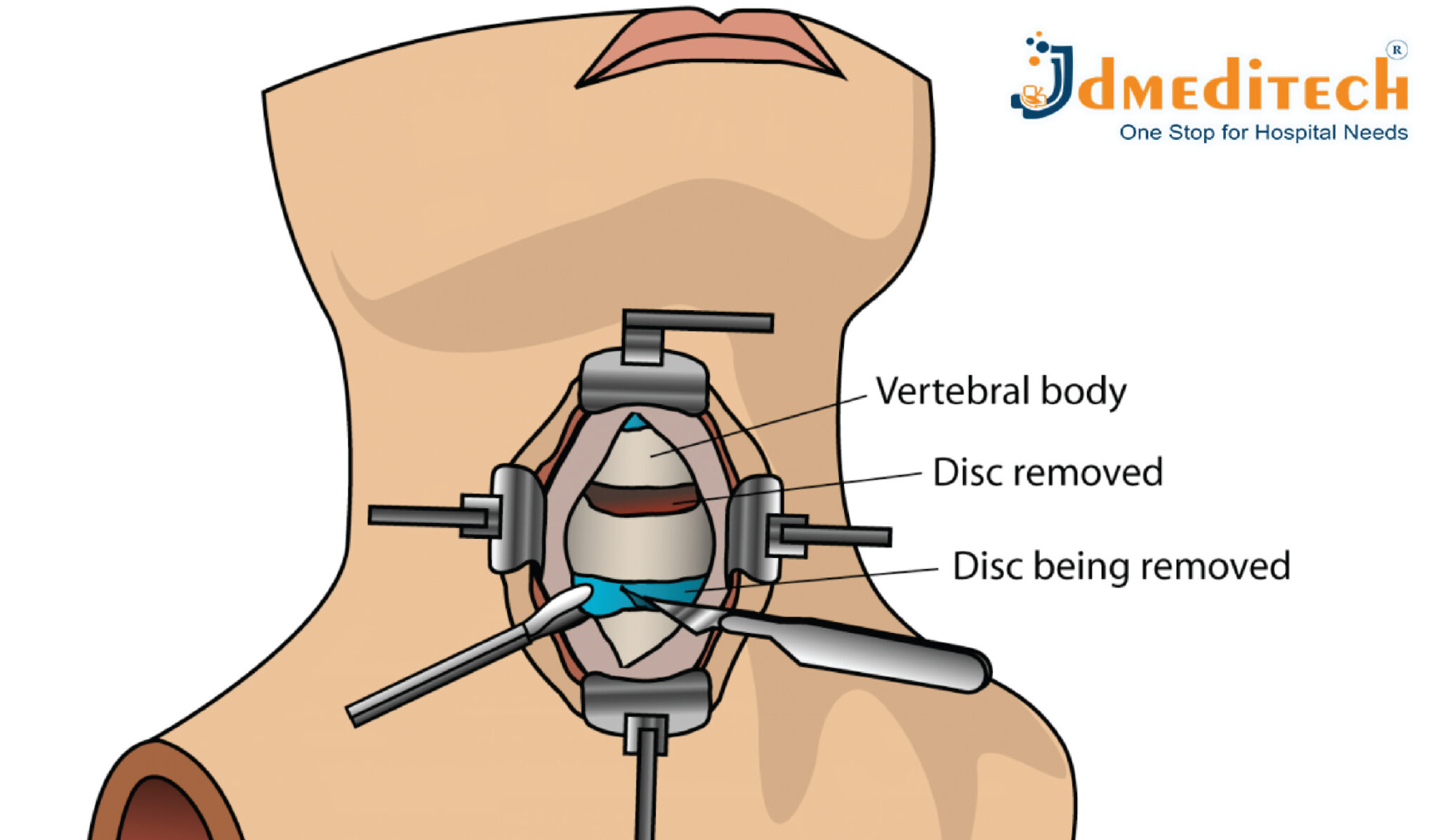 ACDF (Anterior Cervical Discectomy And Fusion) Surgery - jdmeditech