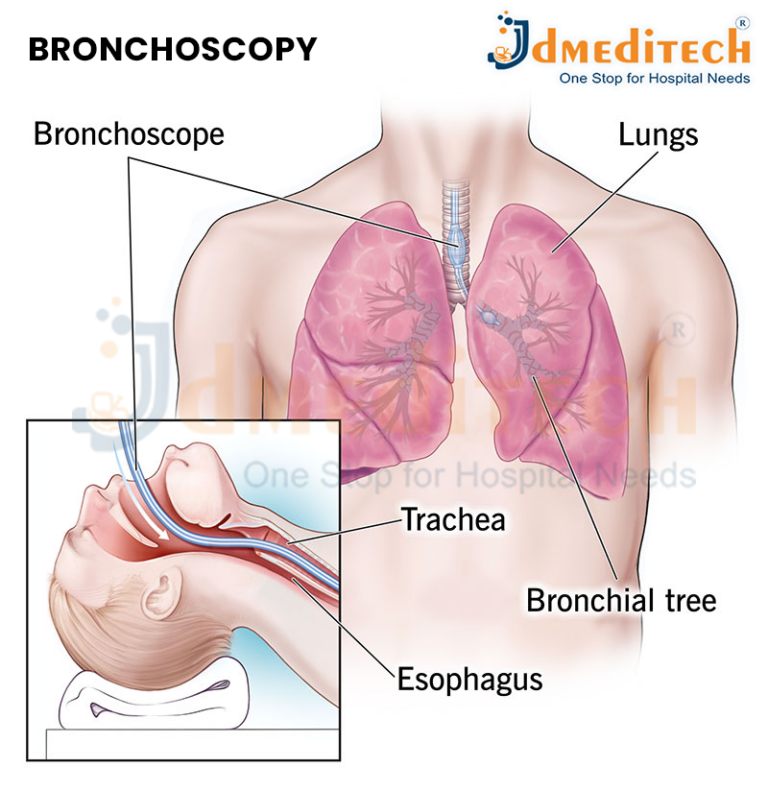 Bronchoscopy - jdmeditech