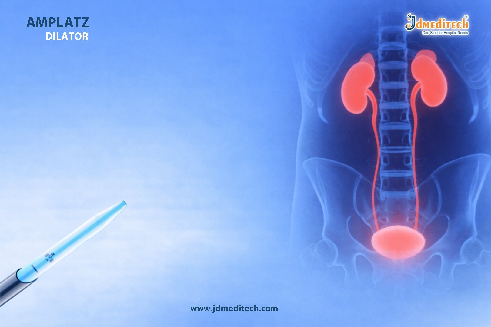 Amplatz Renal Dilator for Minimally Invasive Access