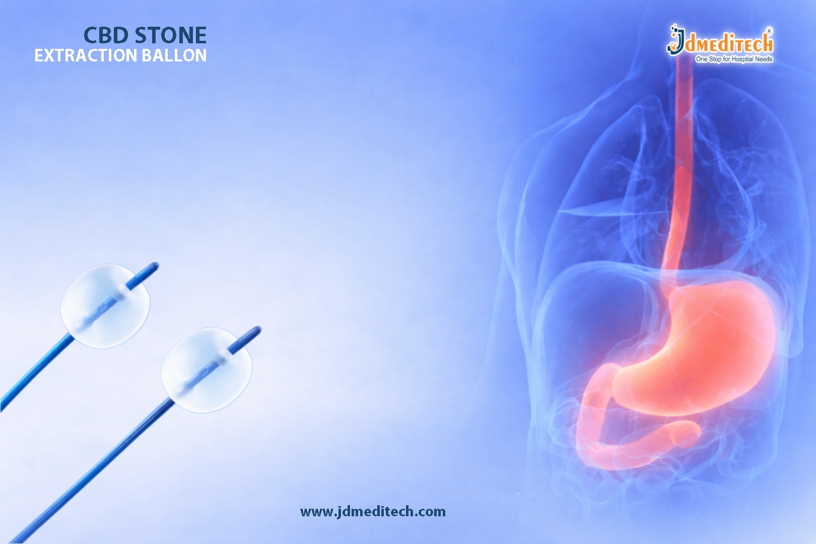 Safe ERCP Stone Removal with CBD Stone Extraction Balloon