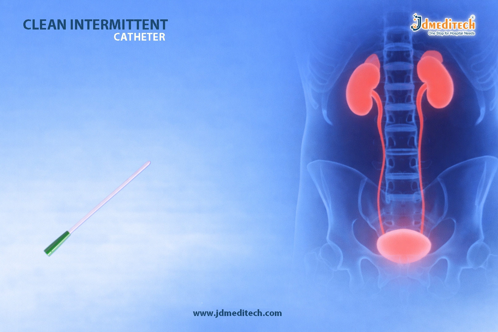Clean Intermittent Catheter (CIC) – Safe Bladder Emptying Solution