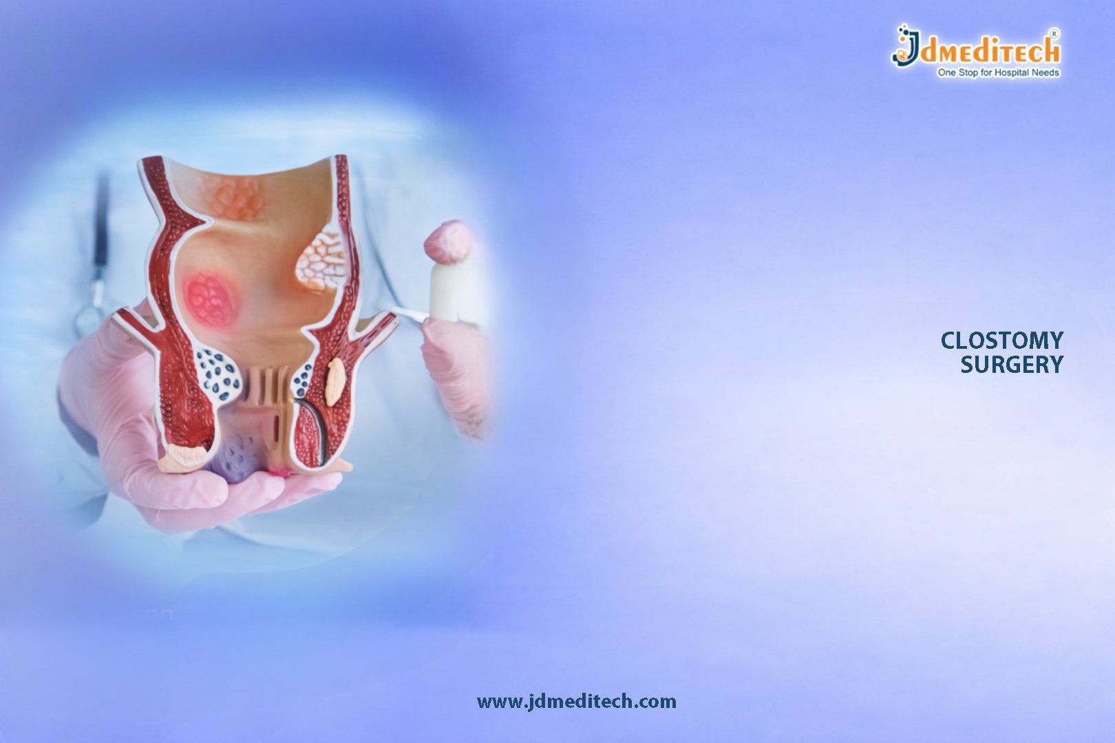 Colostomy Surgery – Effective Treatment for Intestinal Conditions