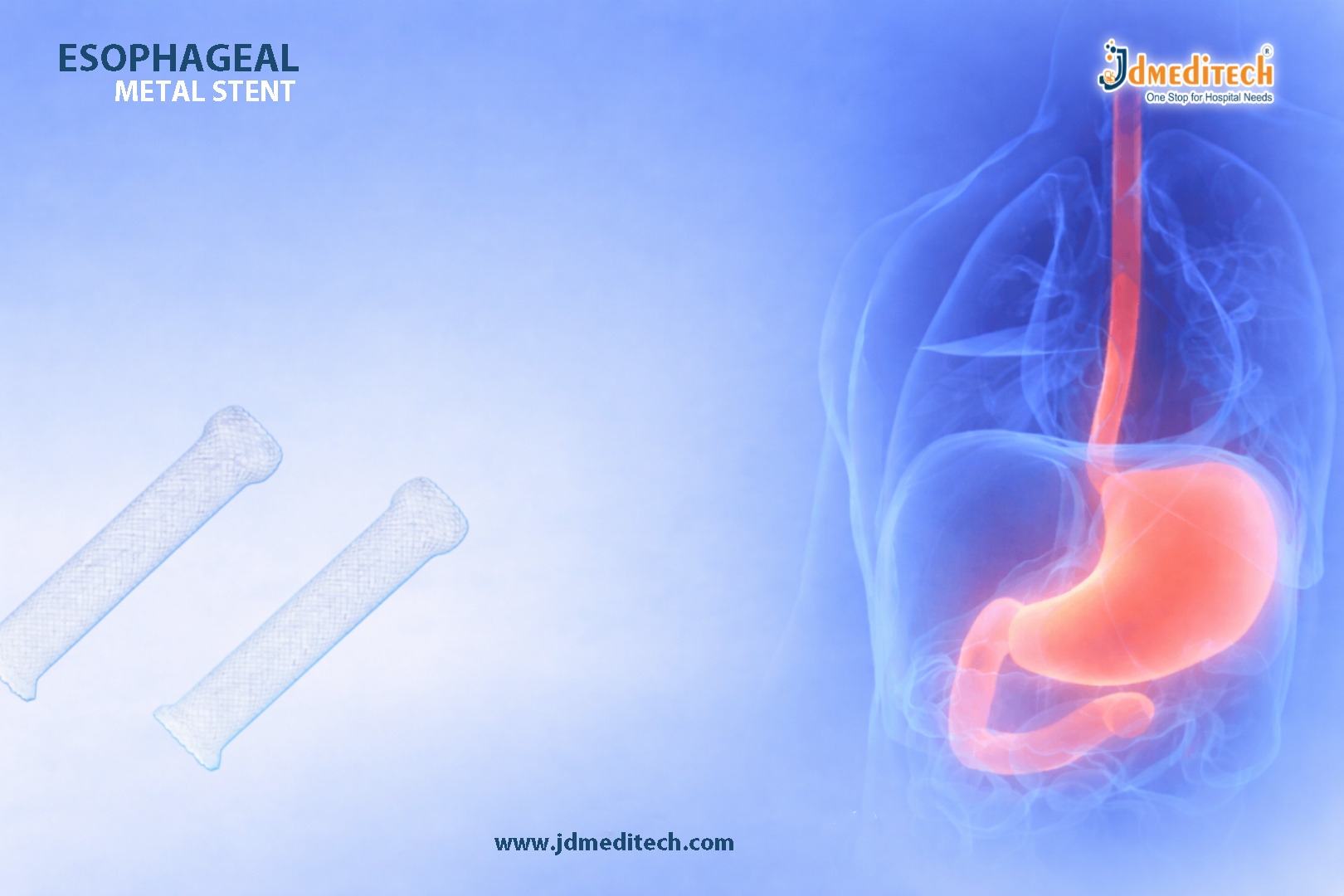 Esophageal Metal Stents for Dysphagia Relief | Advanced GI Care