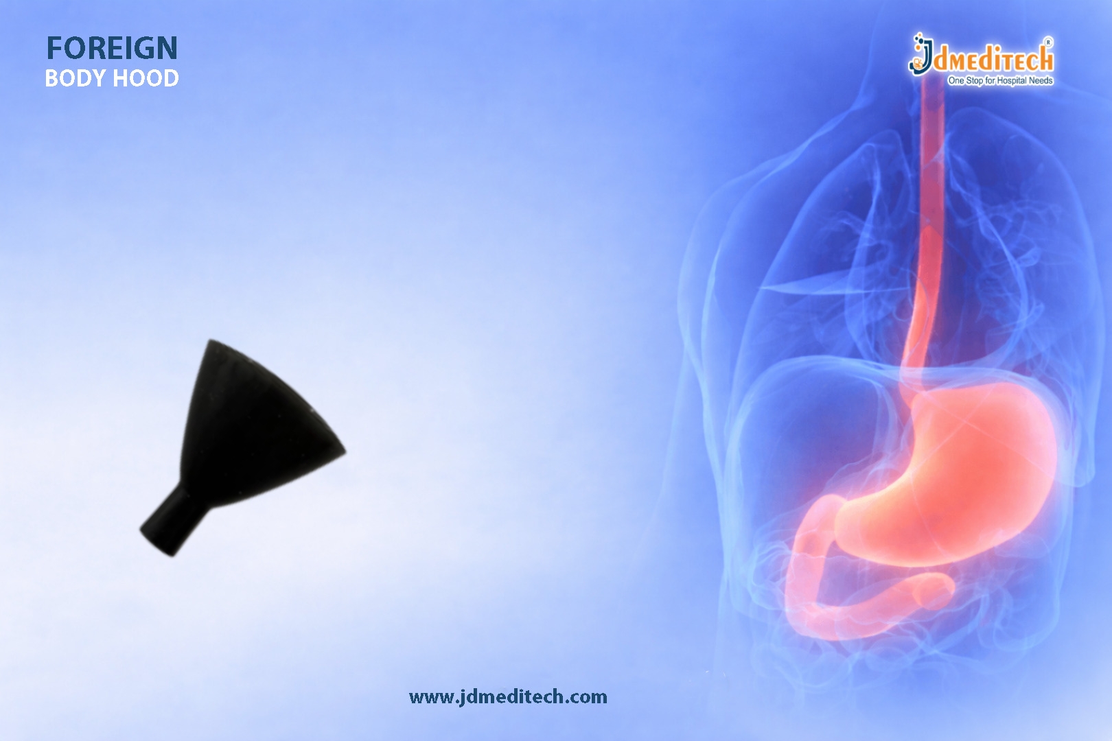 Safe Retrieval Made Simple – Foreign Body Hood in Endoscopy