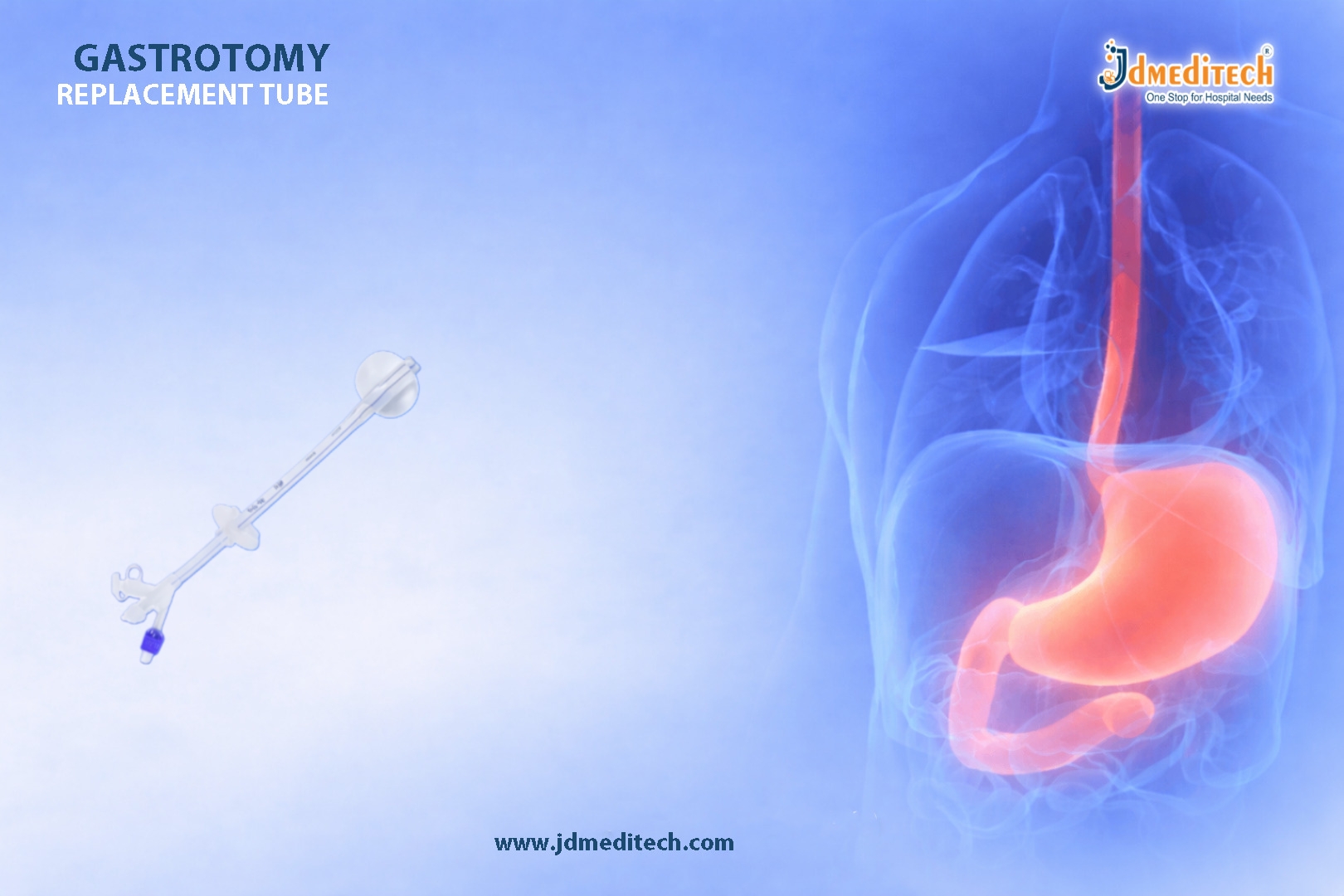 Gastrostomy Replacement Tubes for Safe Enteral Nutrition
