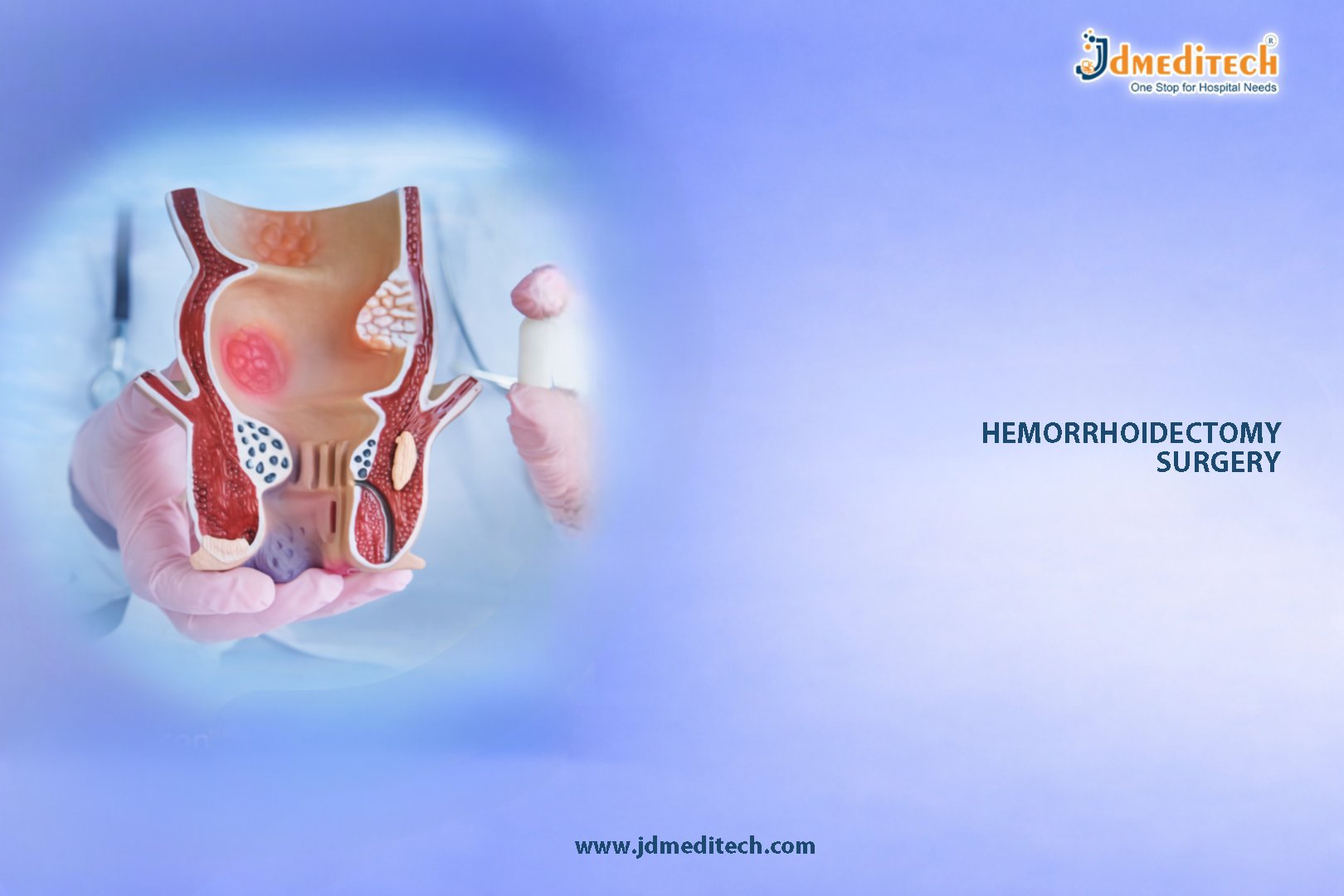 Hemorrhoidectomy – A Surgical Solution for Hemorrhoids