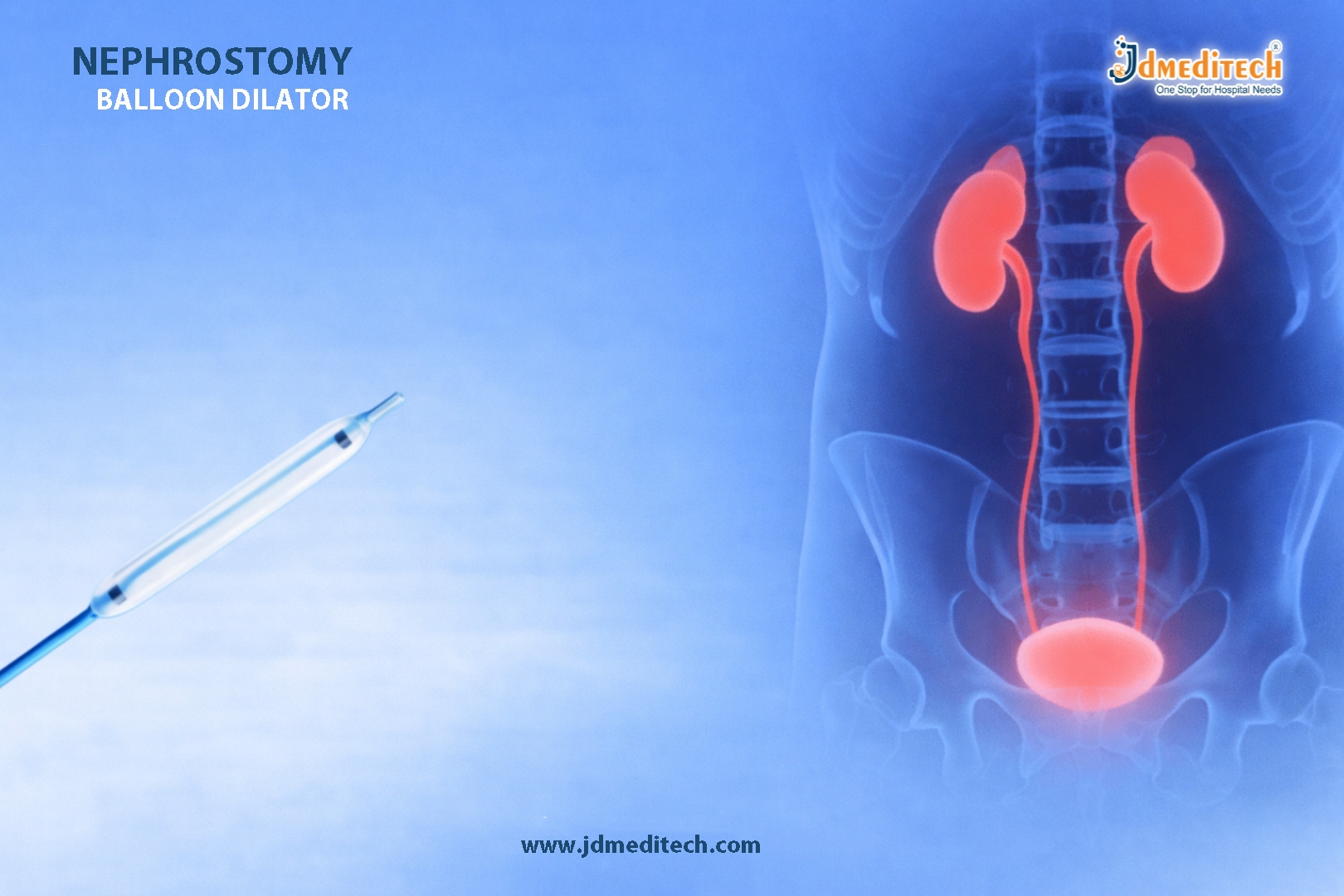 Nephrostomy Balloon Dilator for PCNL | Precision Tract Dilation