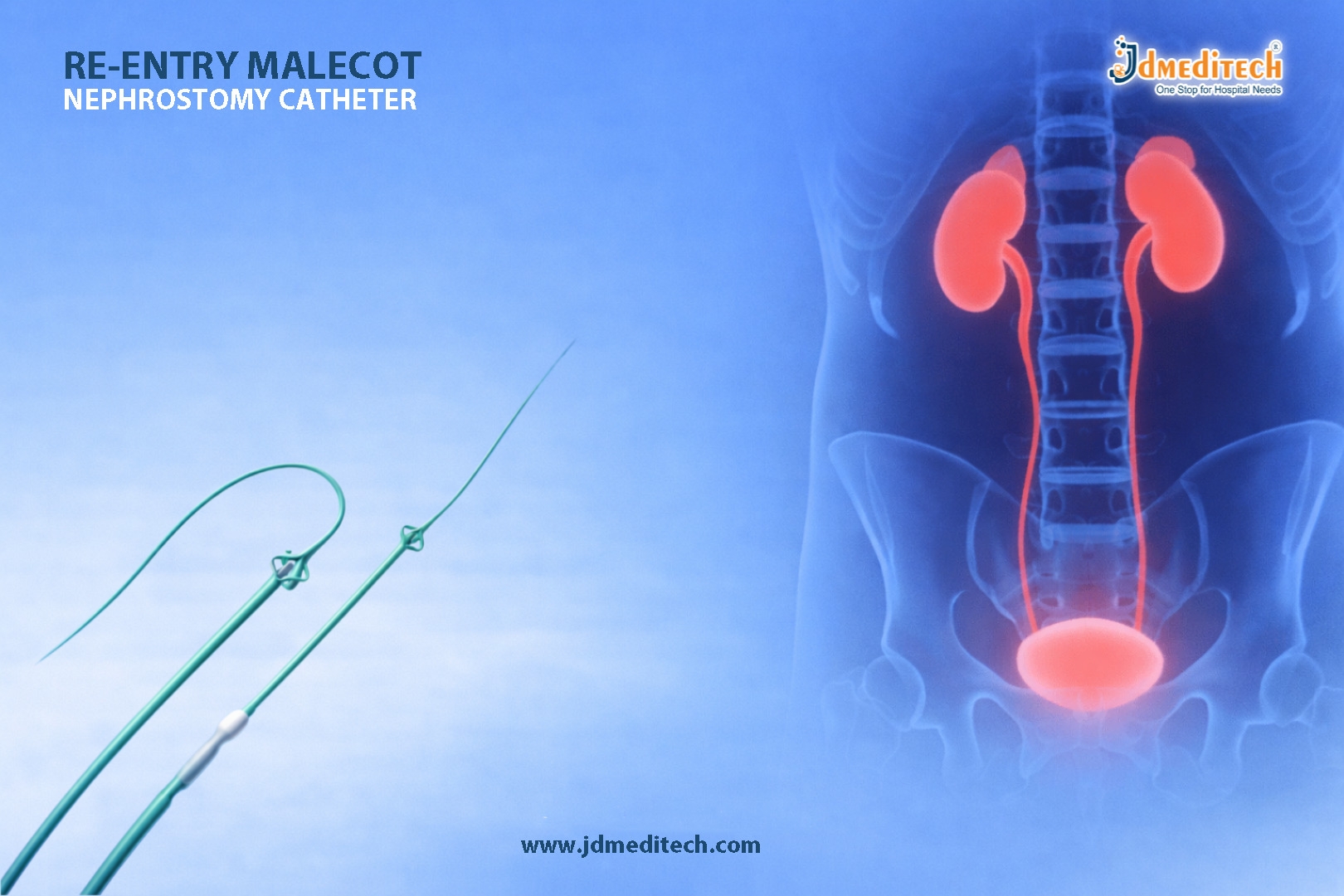 Re-Entry Malecot Nephrostomy Catheter for Drainage