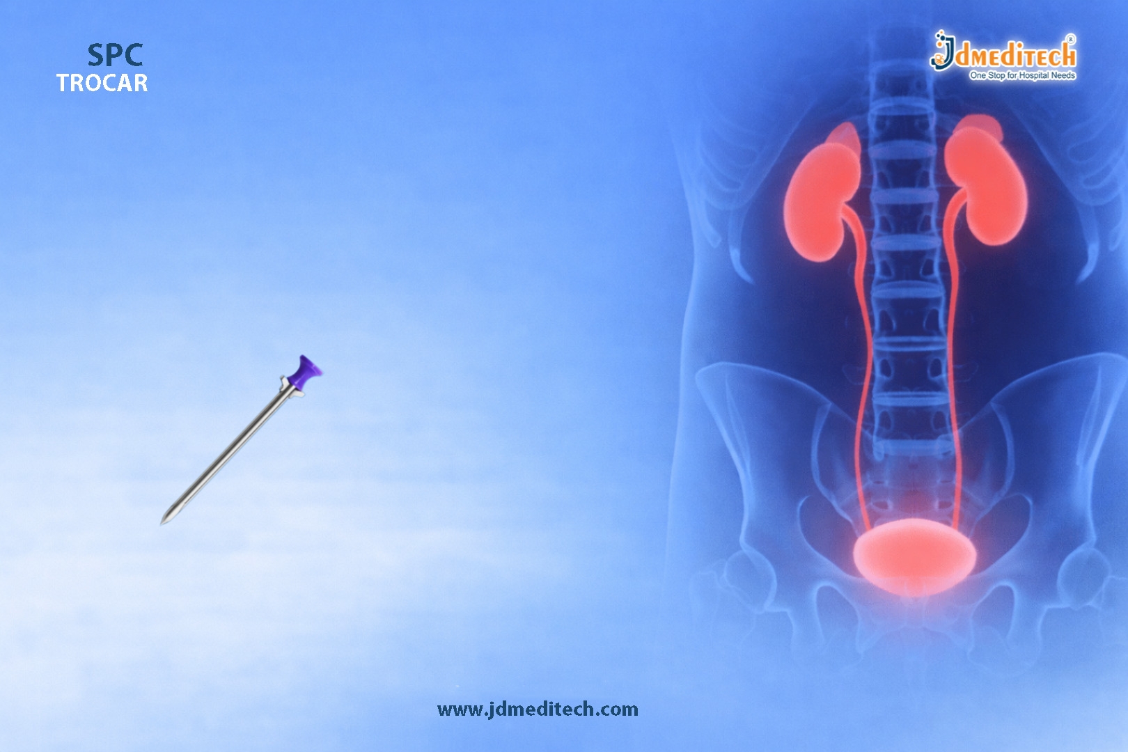 SPC Trocar: Safe Tool for Suprapubic Catheterization