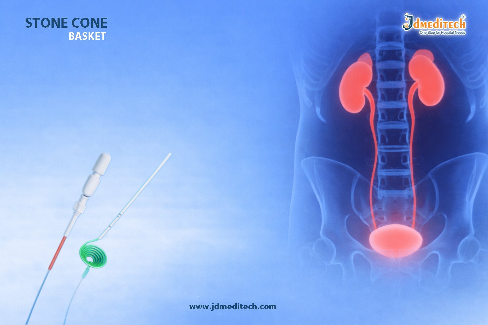 Stone Cone Basket – Prevent Stone Migration in Urology
