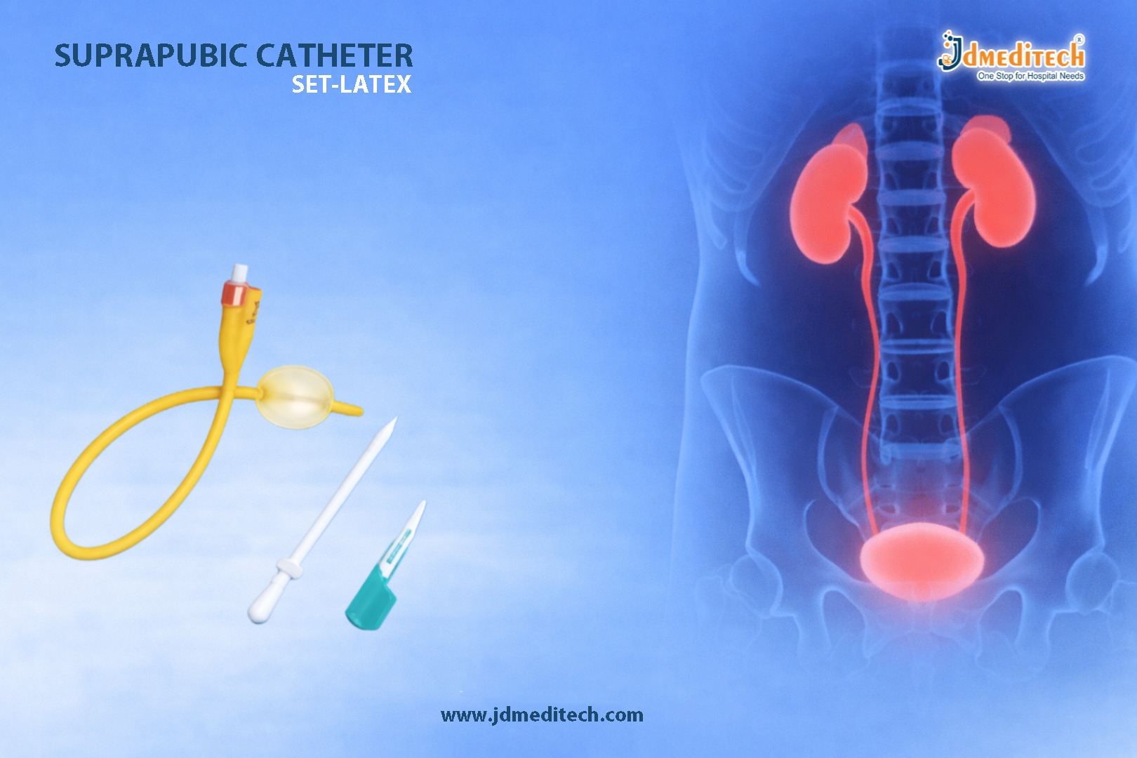 Suprapubic Catheter Set Latex for Long-Term Bladder Drainage