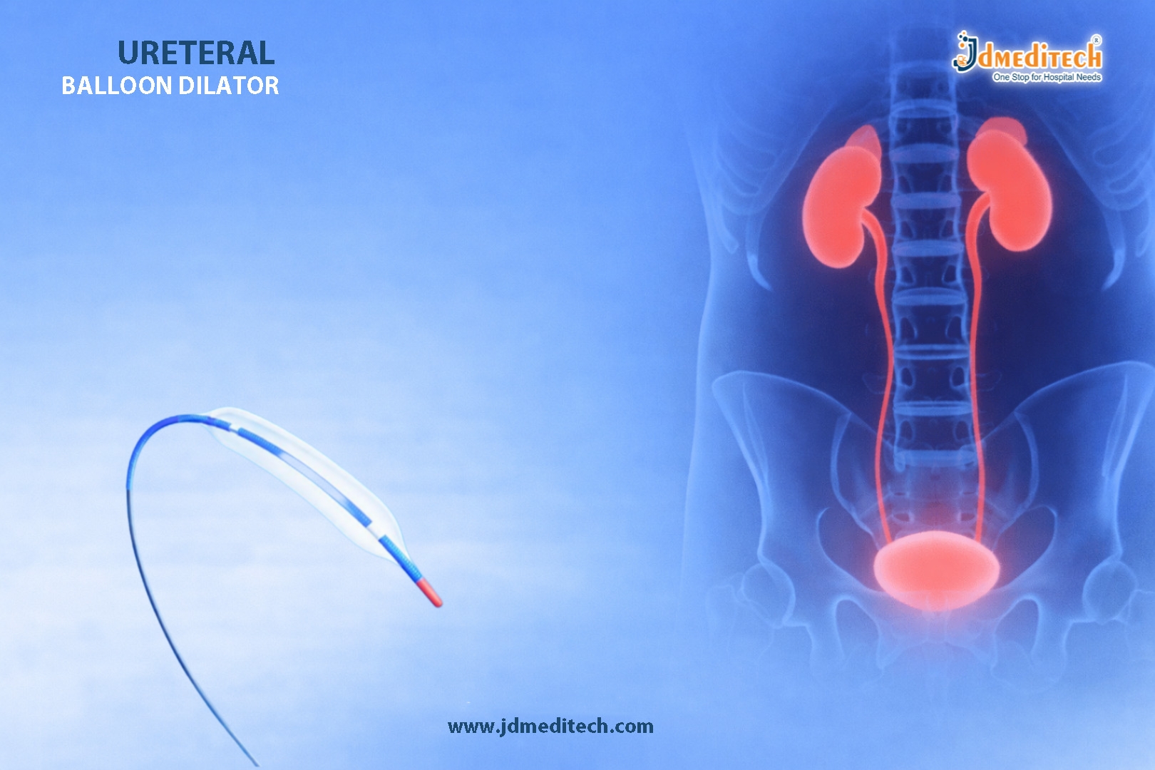 Ureteral Balloon Dilator for Precise Ureteral Stricture Treatment