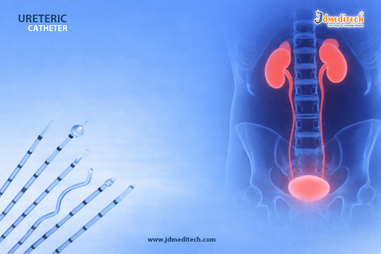 Ureteric Catheter for Temporary Drainage and Ureteral Access