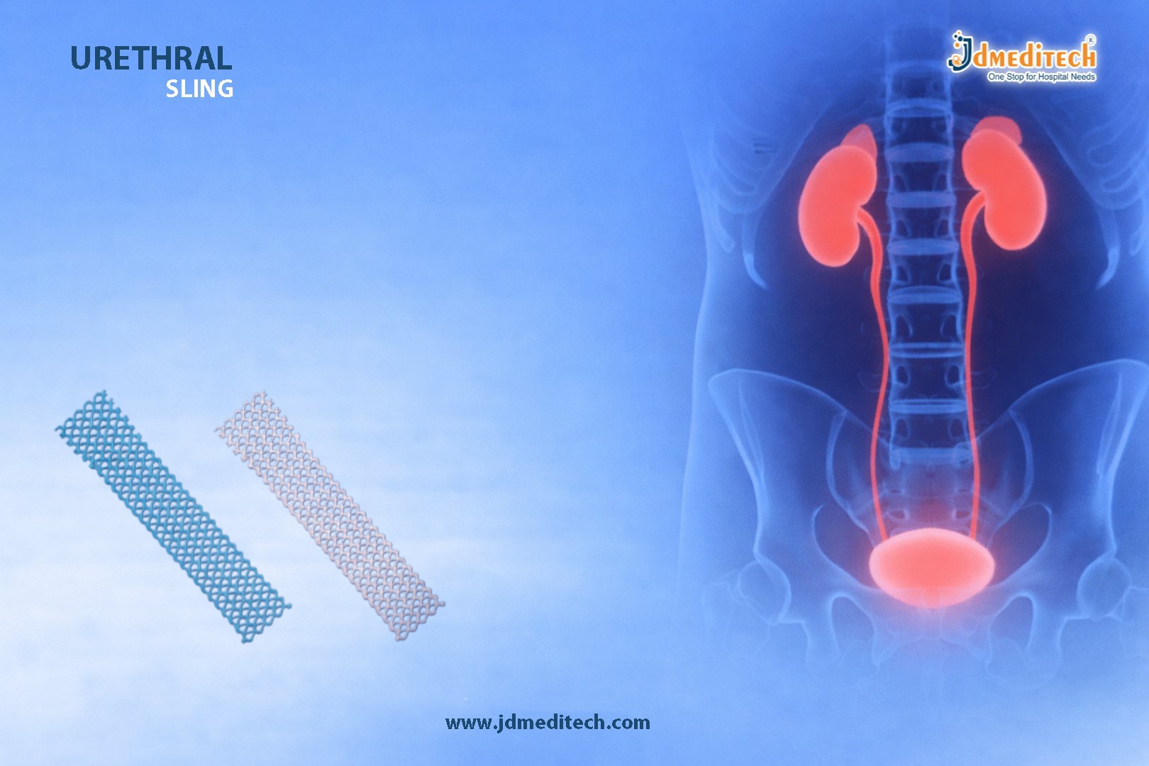 Urethral Sling for Stress Urinary Incontinence Treatment