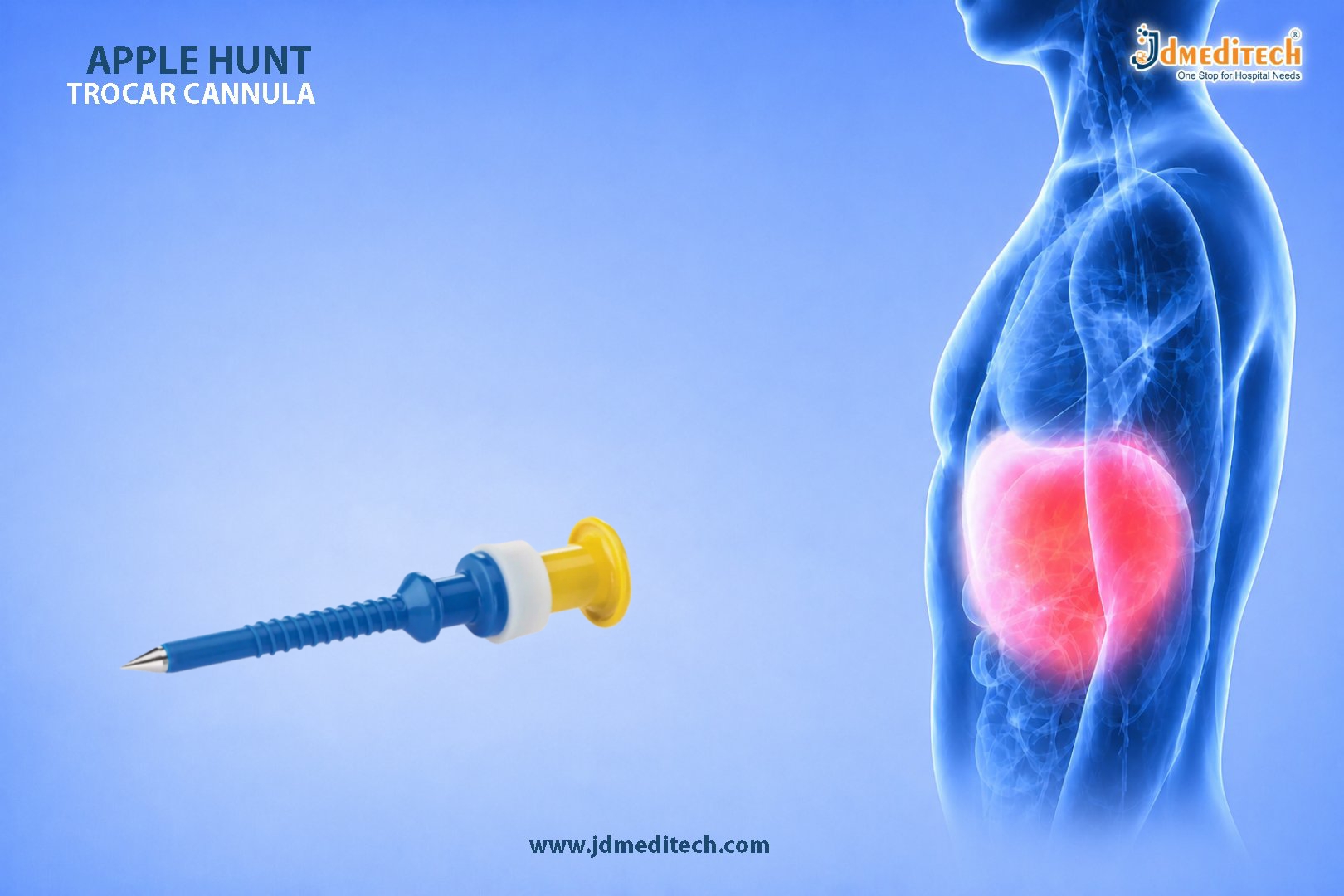 Apple Hunt Trocar Cannula for Safe Laparoscopic Surgery