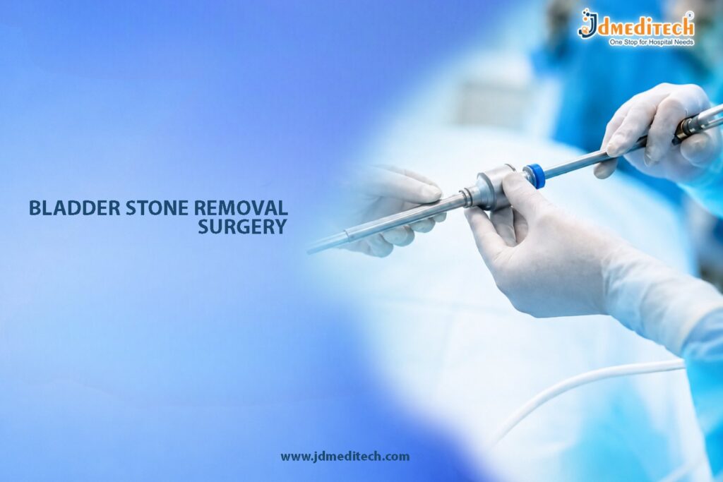 Bladder Stone Removal Surgery – Advanced Treatment for Bladder Stones