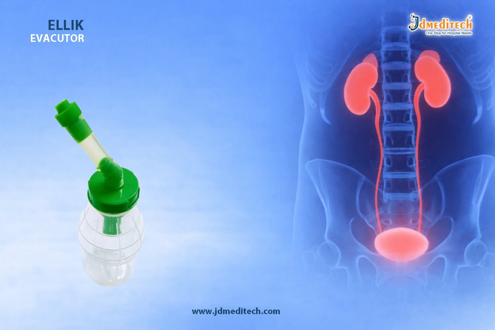 Ellik Evacuator for TURP – Efficient Bladder Evacuation Device