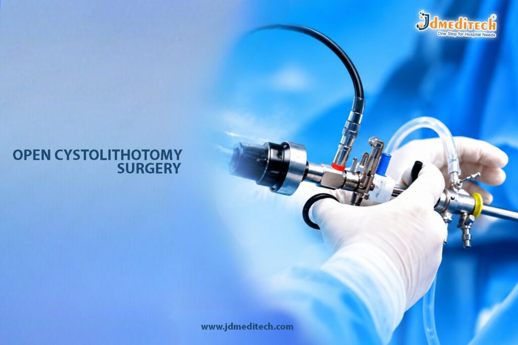 Open Cystolithotomy Surgery – Surgical Treatment for Large Bladder Stones