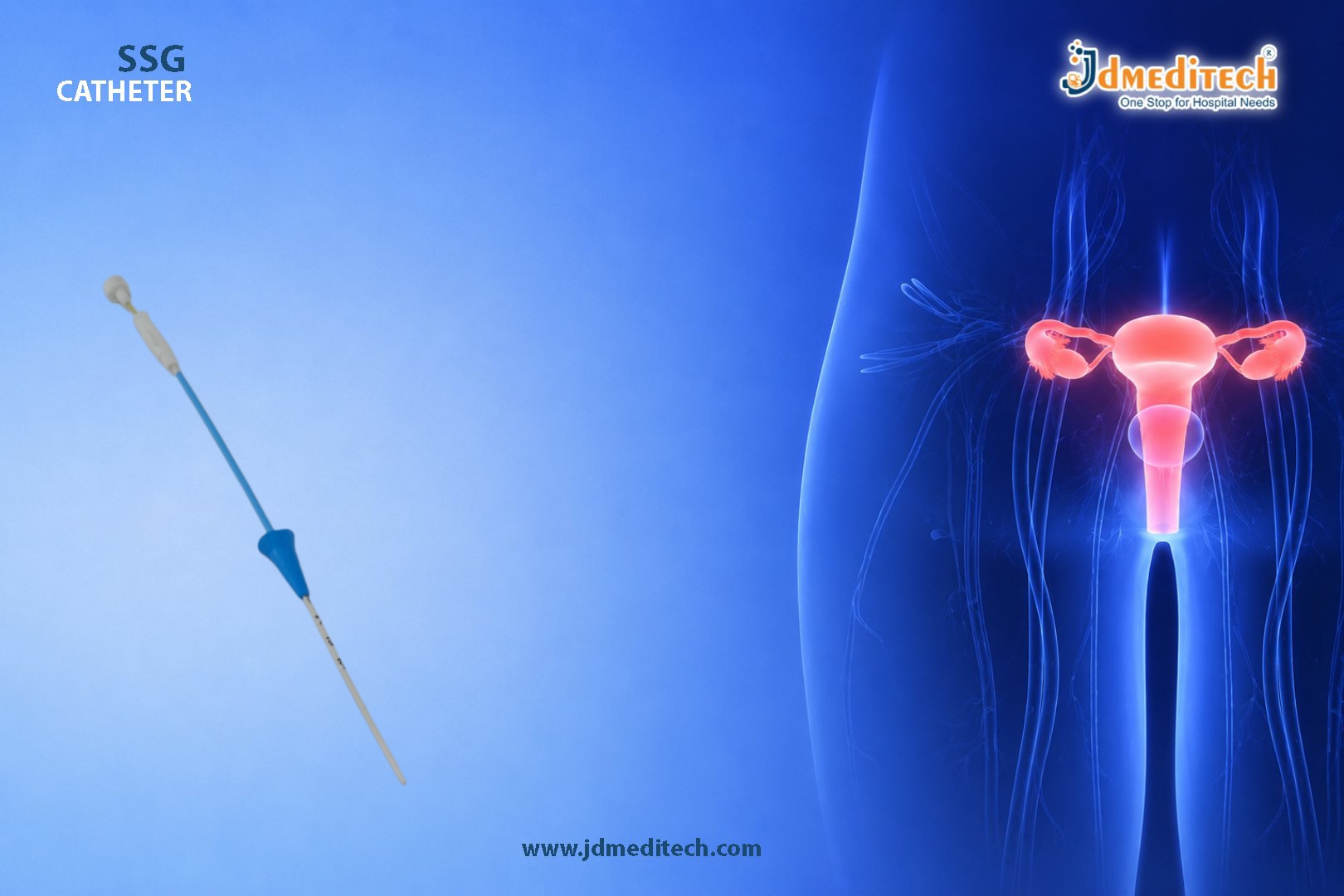 SSG Catheter – Advanced Solution for Accurate Fertility Evaluation
