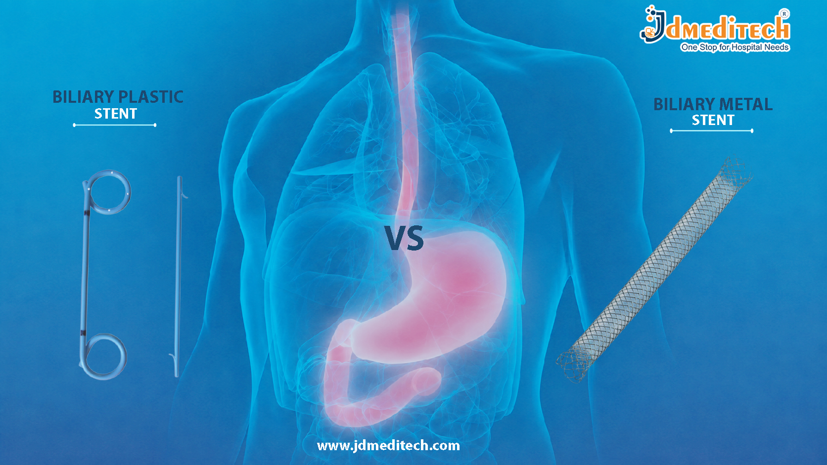 Biliary Plastic vs Metal Stent: Key Differences