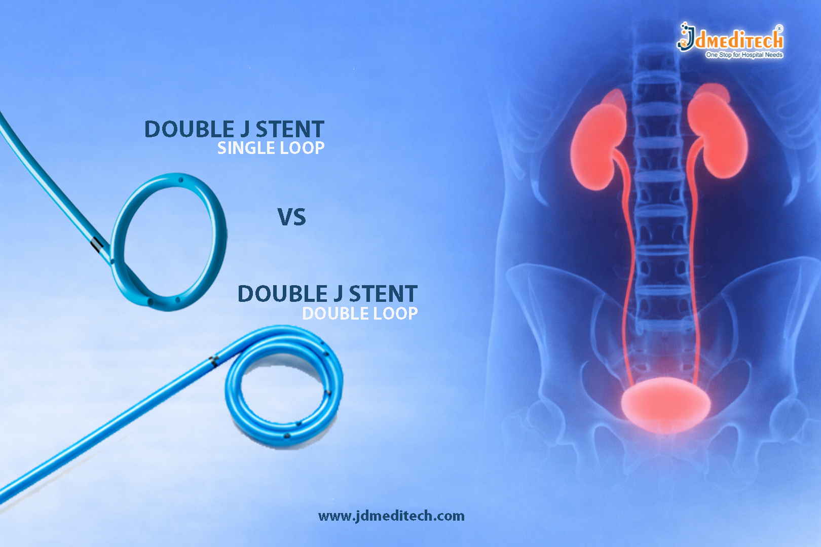 Double J Stent Single Loop vs Double J Stent Multi Loop: Which Design Is Better?
